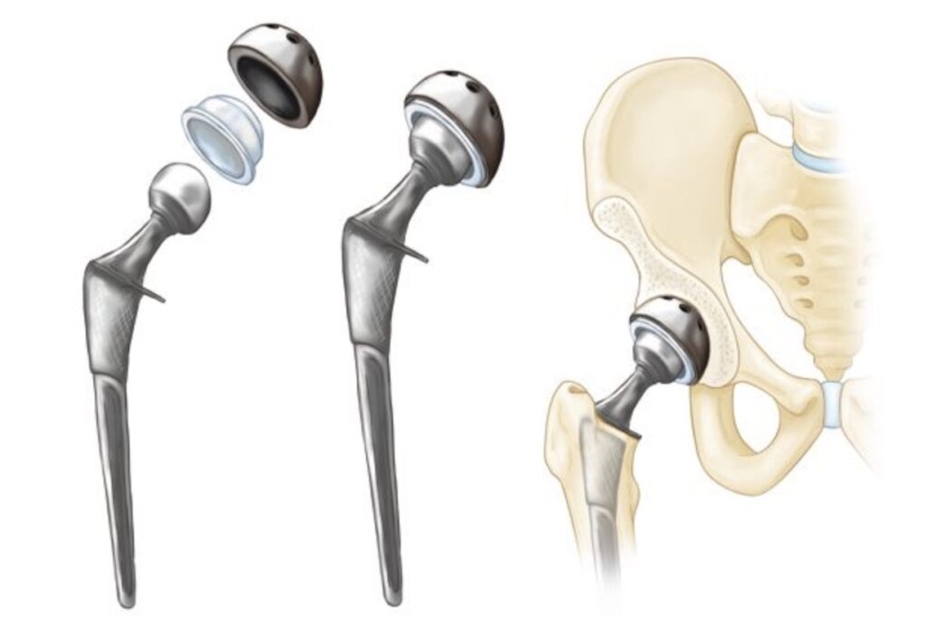 Total Hip Replacement